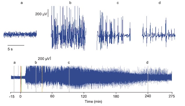Seizure EEG